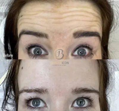 BEAUTY ICON botox Almere