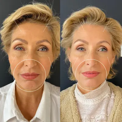 Aēstec Amsterdam botox Amsterdam