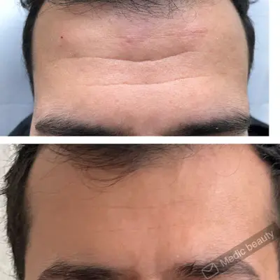 Medic Beauty botox Gelderland