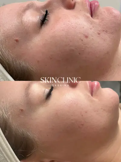 Skin Clinic Sabrina botox Beverwijk