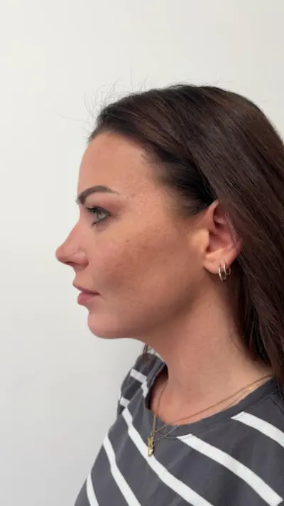 Faceland Bilthoven botox Bilthoven