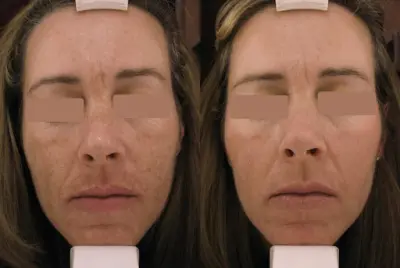 De Huidkliniek Bussum botox Bussum