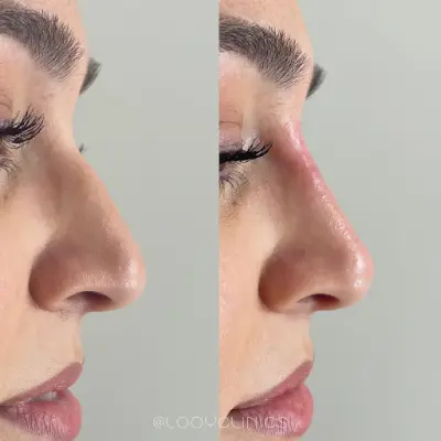 LOOY Clinics botox Deventer