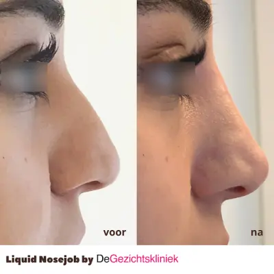 De Gezichtskliniek botox Didam