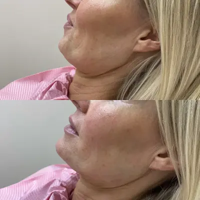 FillerHouse botox Dordrecht