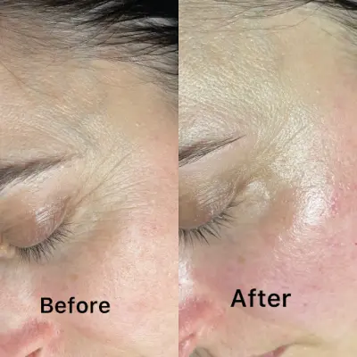 Beauty Clinic Hadisa botox Etten-Leur