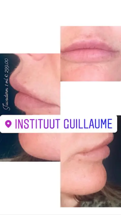 instituut Guillaume botox Geleen