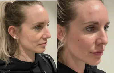 Perfect Look Clinics botox Groningen
