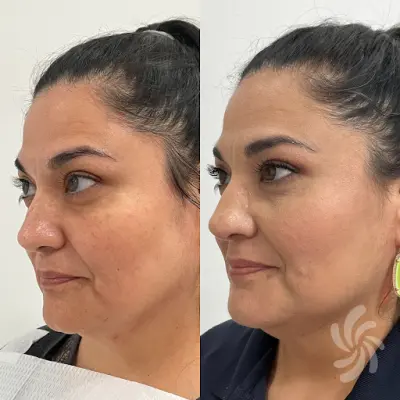 Renovera Medical Wellness & Aesthetic Spa botox Harlingen