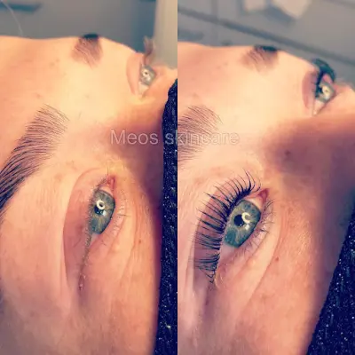 Meos Skincare botox Harmelen