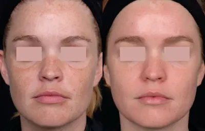 De Huidkliniek botox Heemstede