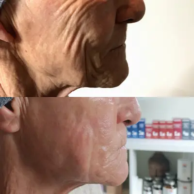 Beauté Nature - Esthetisch Centrum Brandevoort botox Helmond