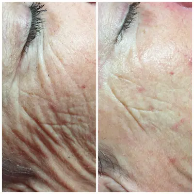 Beautyfarm LaSarel botox Helmond