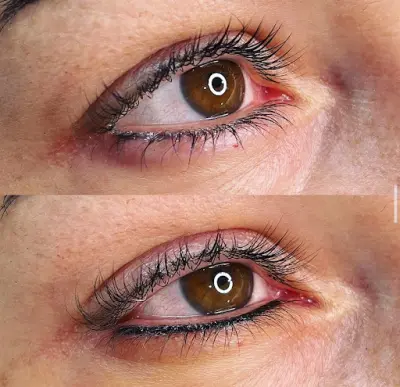 Demi BeautyBarr botox Hendrik-Ido-Ambacht