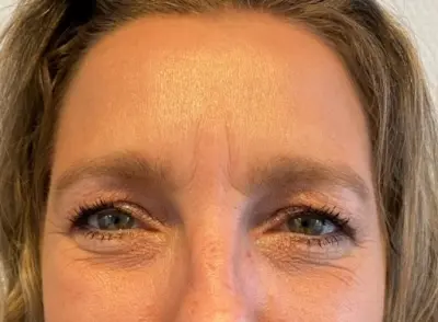 Dokter Poelma botox Hoorn