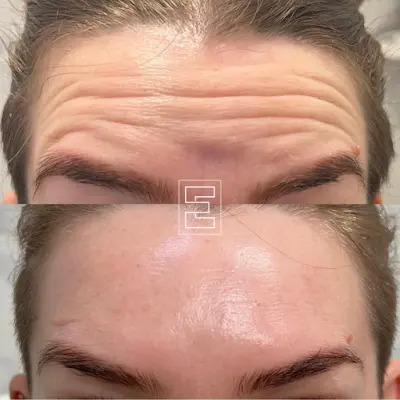 Extended Skin botox Houten