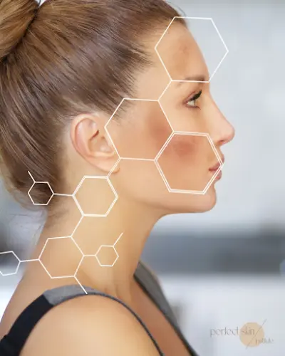 Laser ontharen | Microneedling | Perfect Skin Institute botox IJmuiden