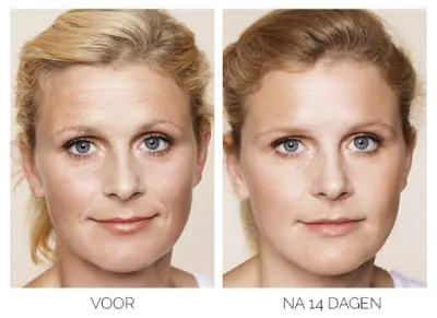 Patrice Visser kliniek botox Laren