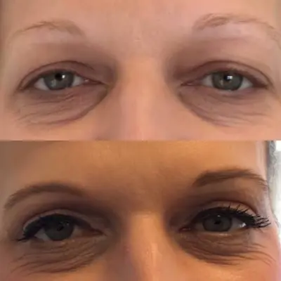 BboClinics botox Maasdam