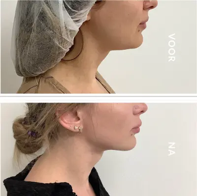 Clinic63 Meerssen botox Meerssen