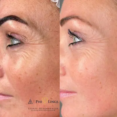Love Aesthetics botox Meppel