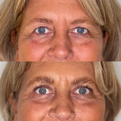 LOOY Clinics botox Olst-Wijhe