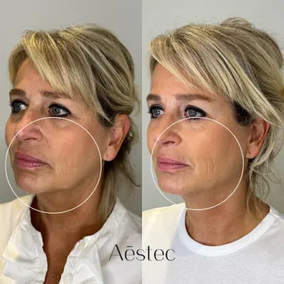 Aēstec Rotterdam botox Rotterdam
