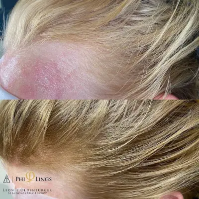 Love Aesthetics botox Staphorst