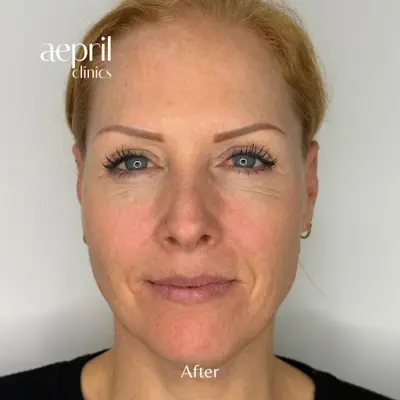 Aepril Cosmetisch Kliniek Utrecht botox Utrecht