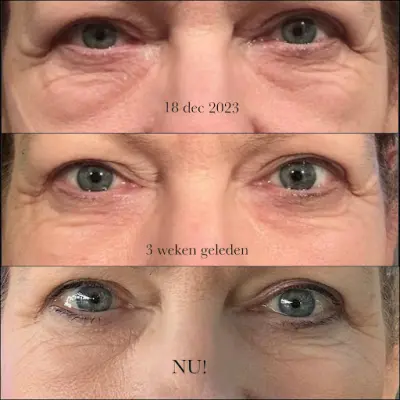 Schoonheidssalon Laperle Lochem botox Vorden