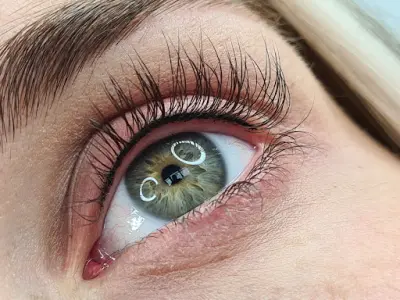 AV pmu botox Wateringen