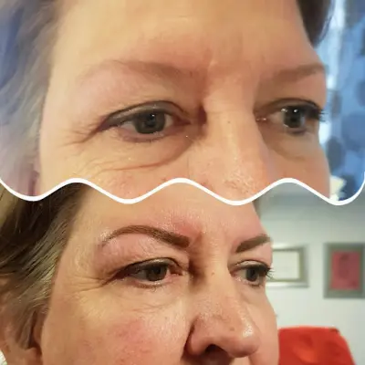 Laserpraktijk Weert botox Weert