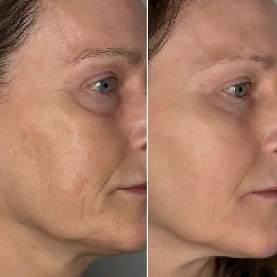 Huidinstituut Roya botox Zaandam