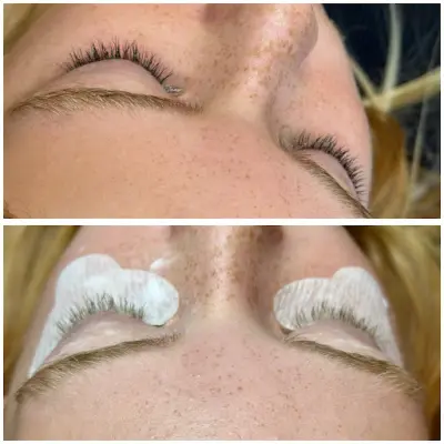 Glow skin center botox Zaltbommel